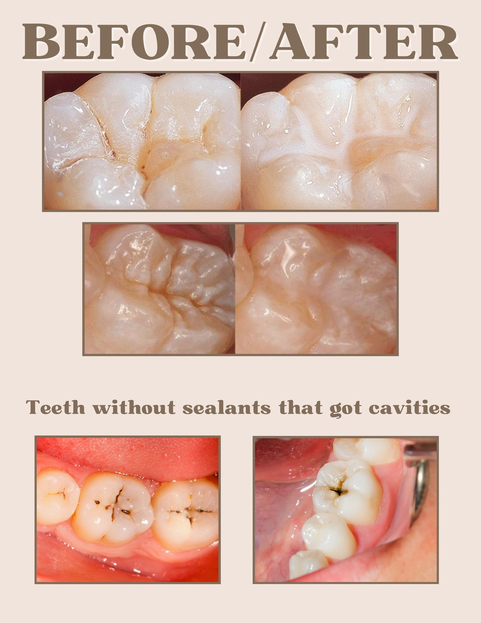 Sealants - 2