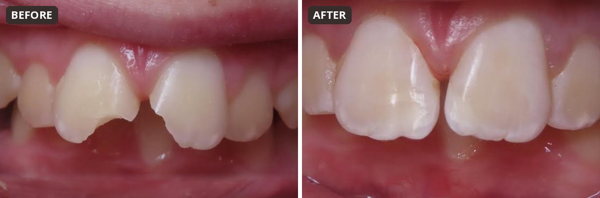 Before and after chipped front tooth repair with color-adapting composite bonding at Peak Pediatric Dentistry