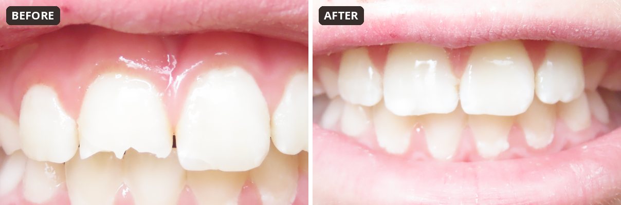 Before and after chipped tooth bonding for a child at Peak Pediatric Dentistry
