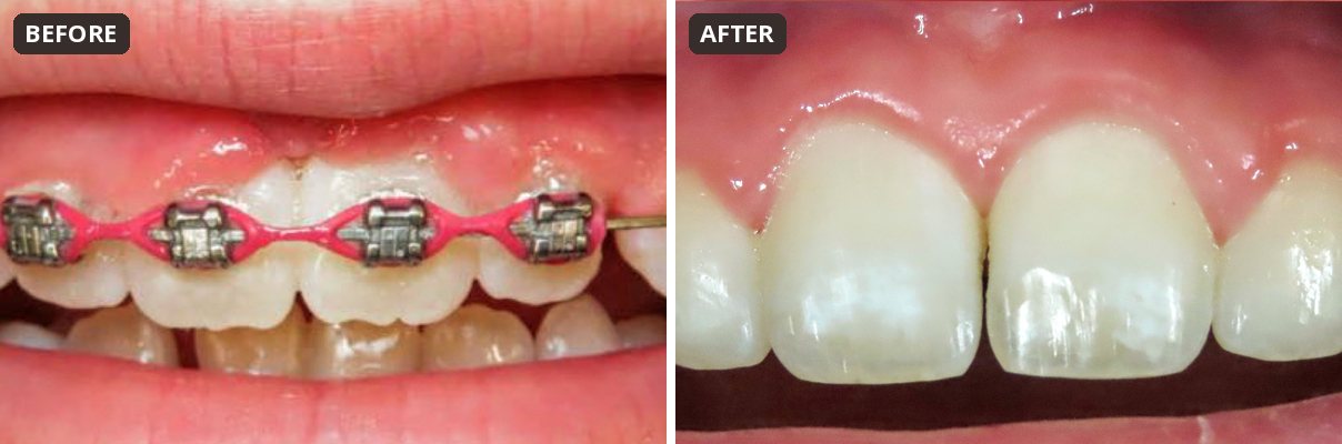 Before and after gingivectomy and bonding after braces at Peak Pediatric Dentistry