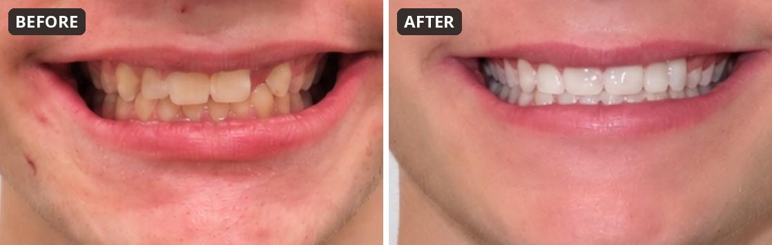 Before and after Maryland bridge and veneers replacing missing teeth without implants at Peak Pediatric Dentistry