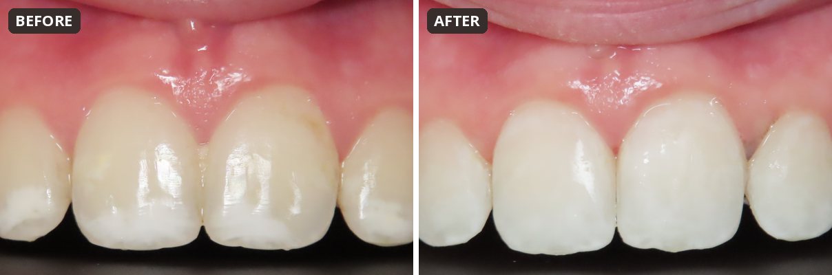 Before and after white spot removal on a teen at Peak Pediatric Dentistry
