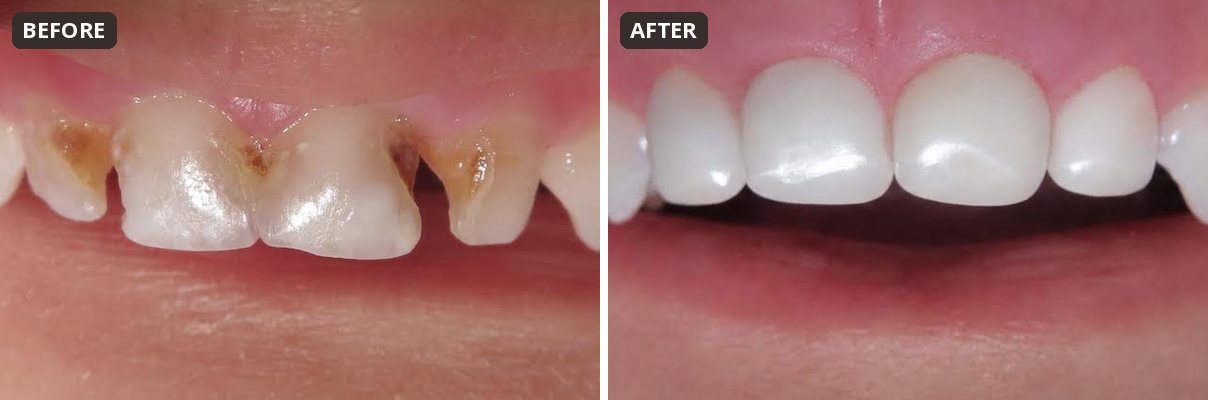 Before and after white zirconia crowns on a child's front teeth at Peak Pediatric Dentistry